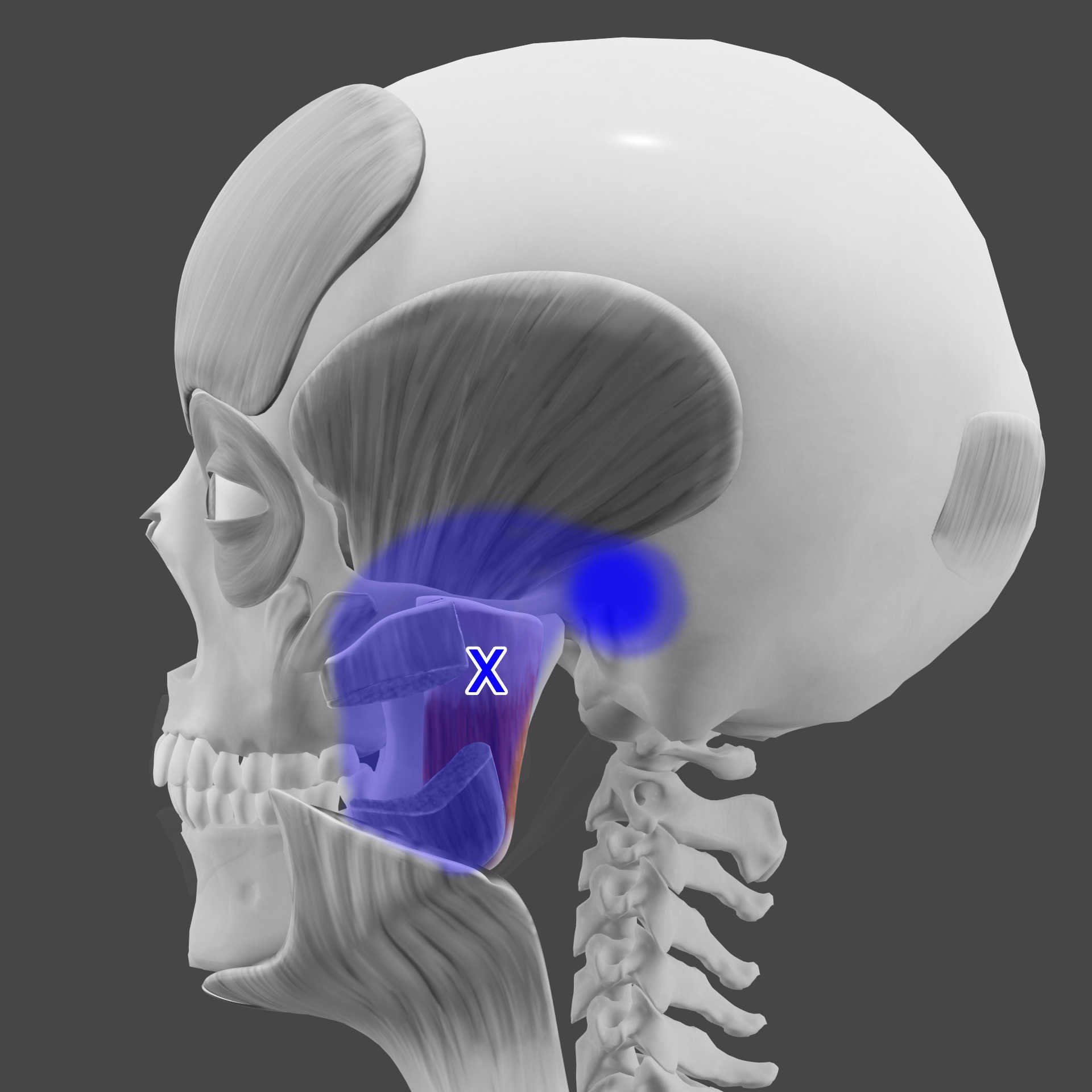 Deep masseter TrP