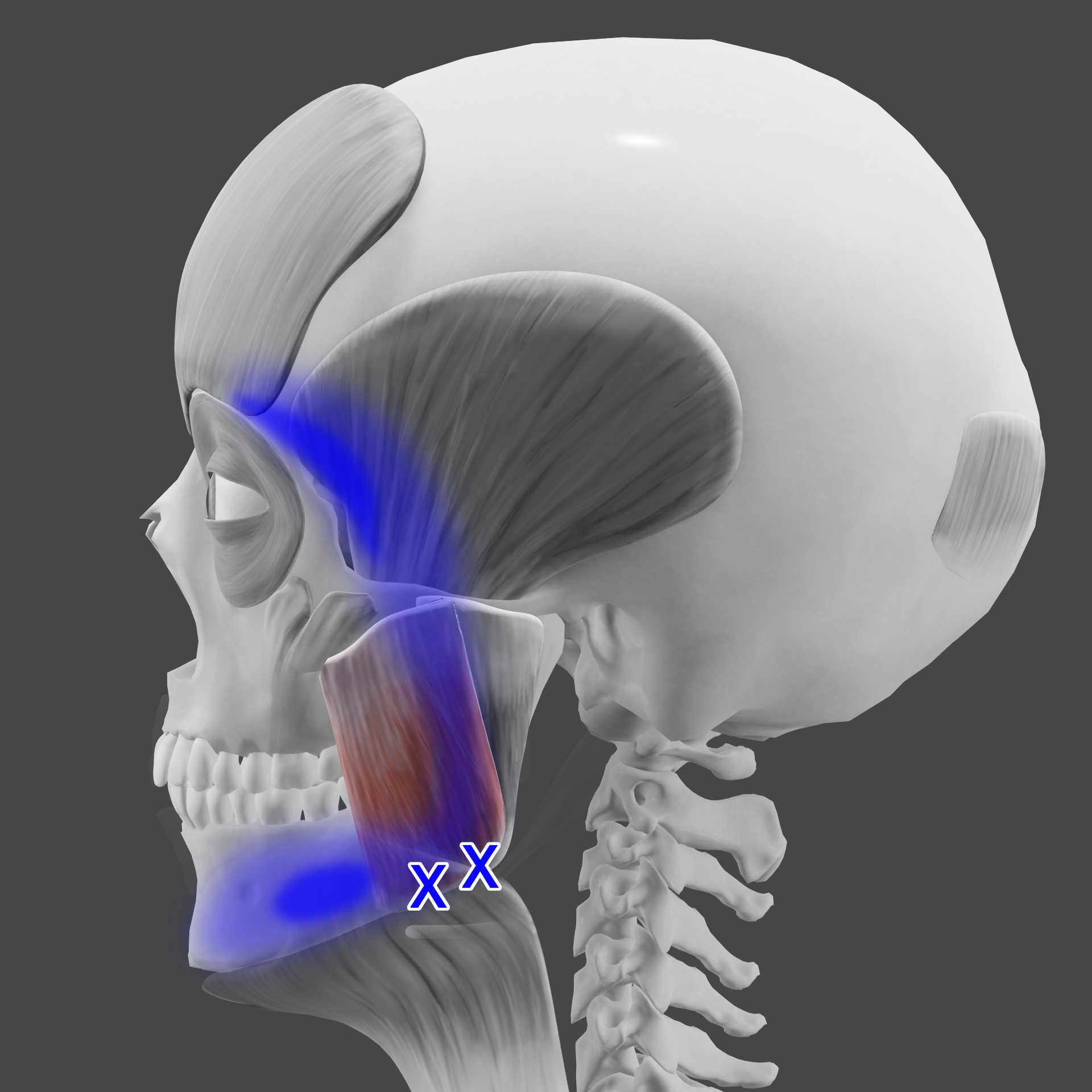 Superficial masseter TrPs