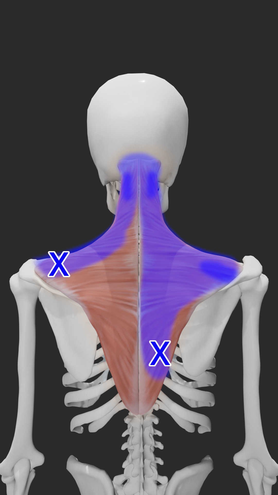 Trapezius trigger points