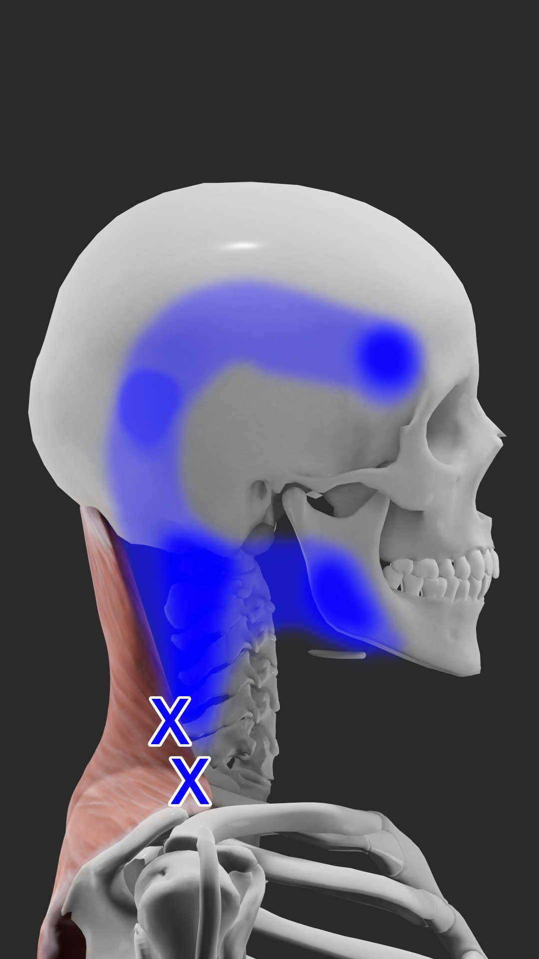 Upper trapezius trigger points